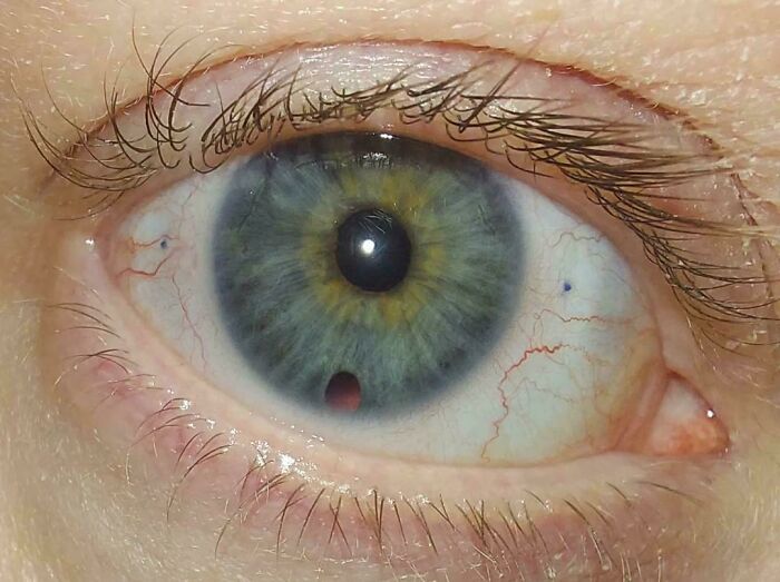 A close-up of an eye with a distinct dark spot on the iris, a fascinating and rare body quirk.