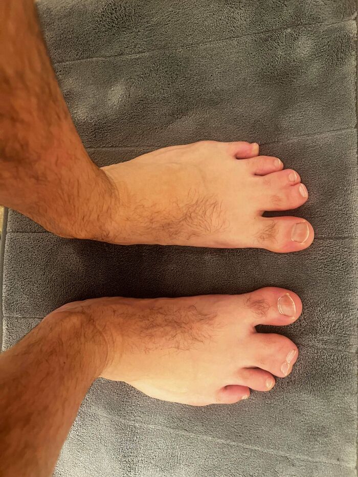 A pair of feet with unusually long second toes, a rare body quirk that left people fascinated.