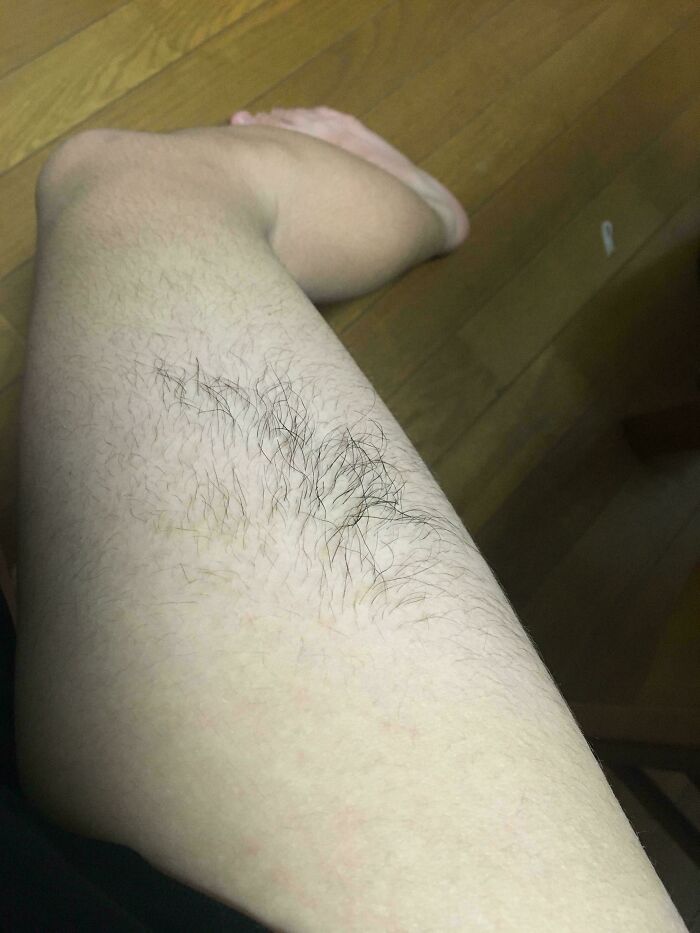 A person's leg with an unusual pattern of hair growth, illustrating a rare body quirk.