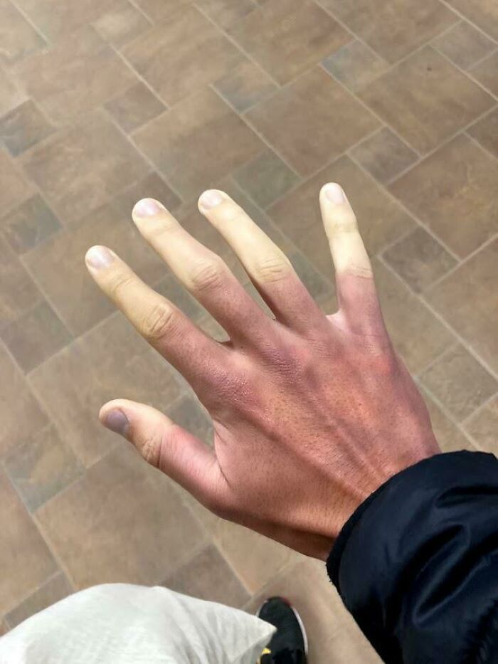 A hand with fingers that are pale yellow while the rest of the hand is reddish-purple, showcasing a rare body quirk.