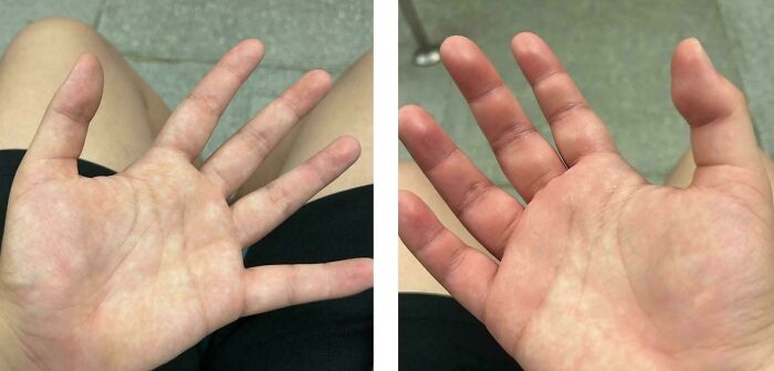 A person's hands showing an unexpected body quirk with differences in appearance.