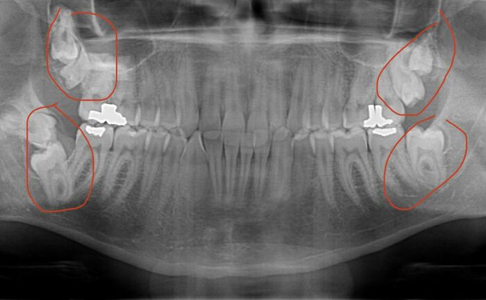 A dental panoramic x-ray showing multiple impacted wisdom teeth circled in red, illustrating body quirks.