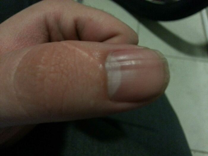 A close-up of a thumb with a distinct white mark on the nail, a rare body quirk.