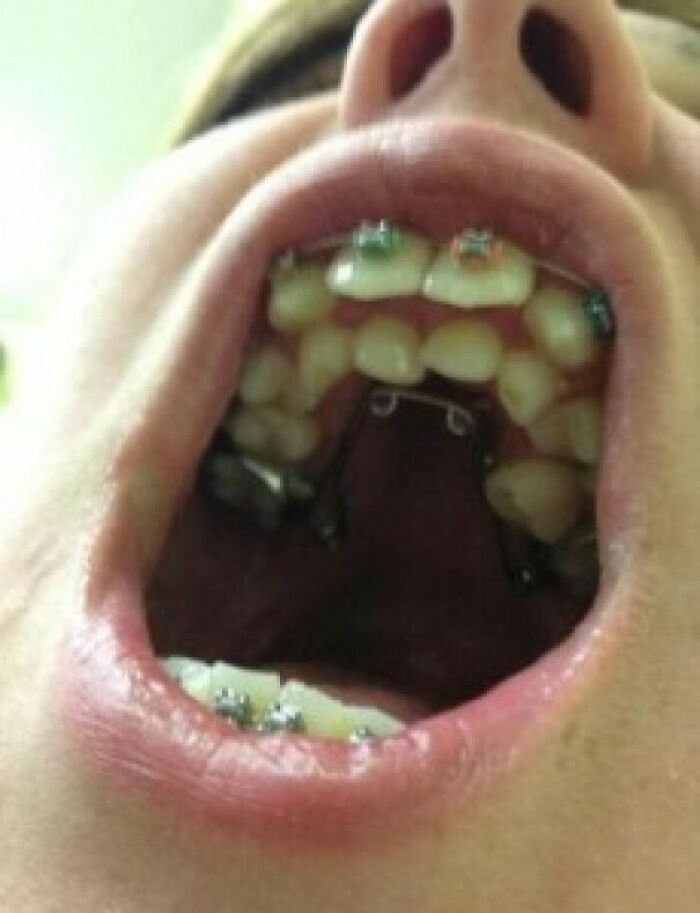A close-up of a person's open mouth revealing dental braces and a palate expander, highlighting body quirks.