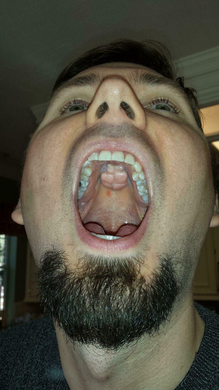 A man looking up with his mouth open, revealing a double uvula, an unexpected body quirk.