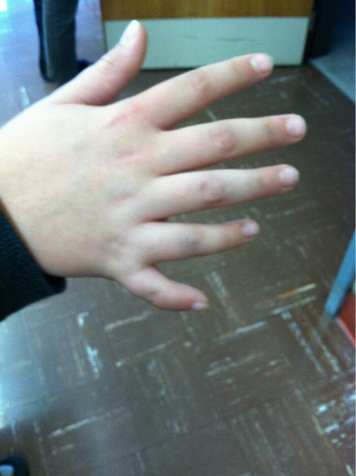 A hand with an unusually short pinky finger, showcasing a unique body quirk.
