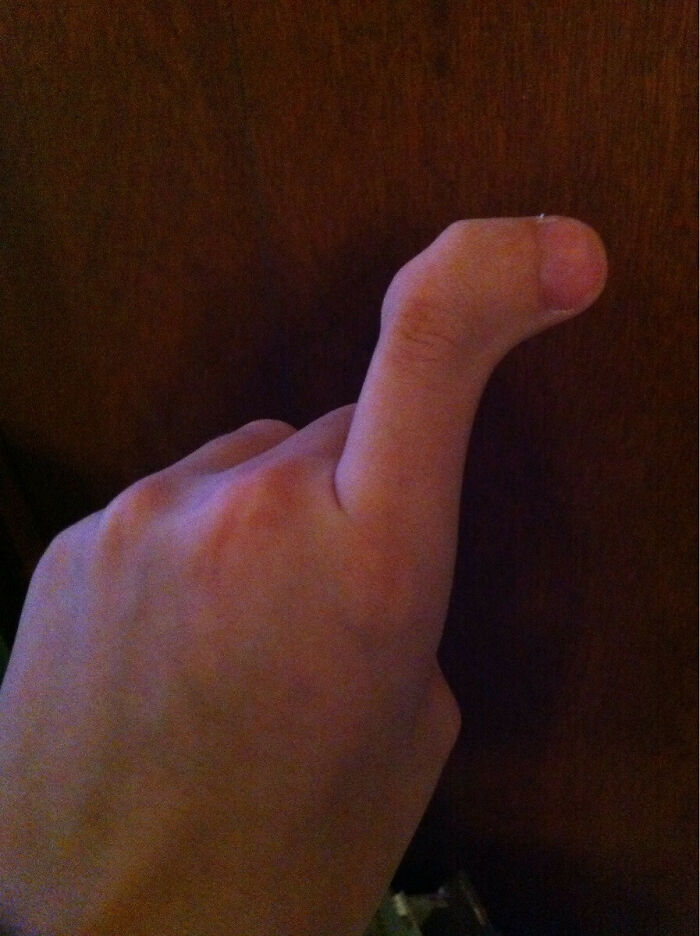 A hand showing a unique thumb bent backward, highlighting a rare body quirk.