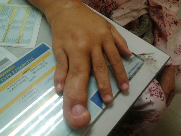A hand with an unusually large thumb, resting on a table, showcasing rare body quirks.