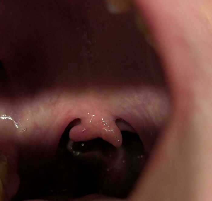 An open mouth showing a split uvula, an unusual body quirk.