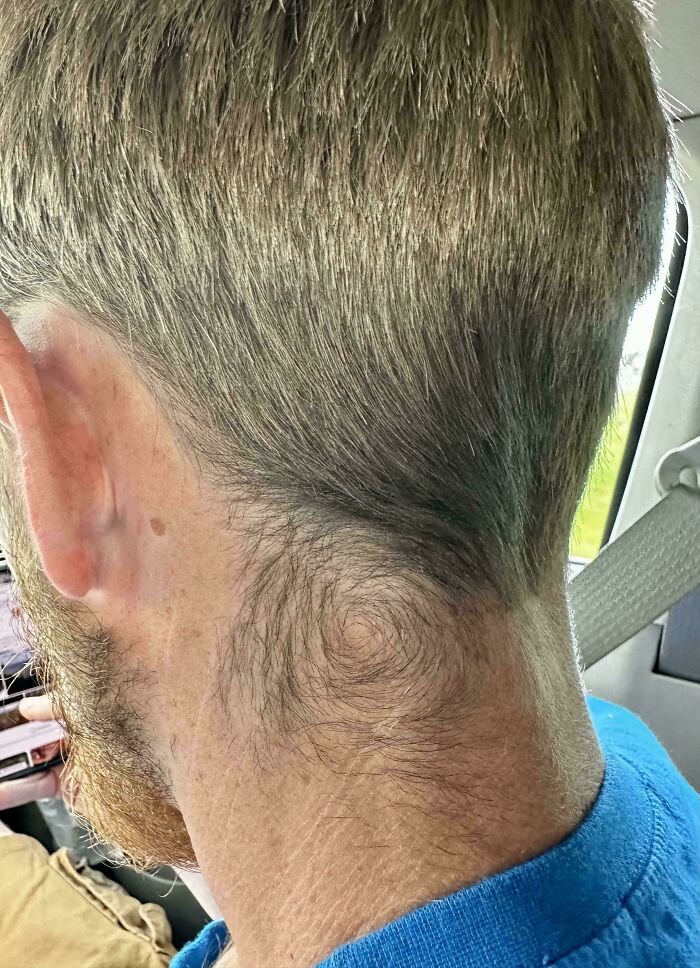 Side view of a man's neck with a spiral hair pattern, highlighting a unique body quirk.