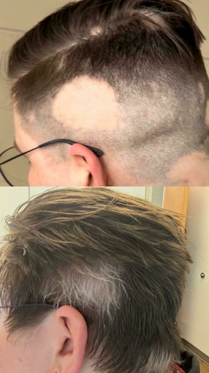 A person's head with large bald patches on the side, highlighting rare body quirks.