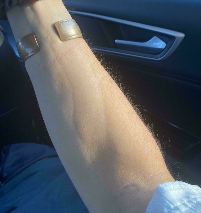 A person's forearm showing a prominent raised vein, an unexpected body quirk or physical trait.