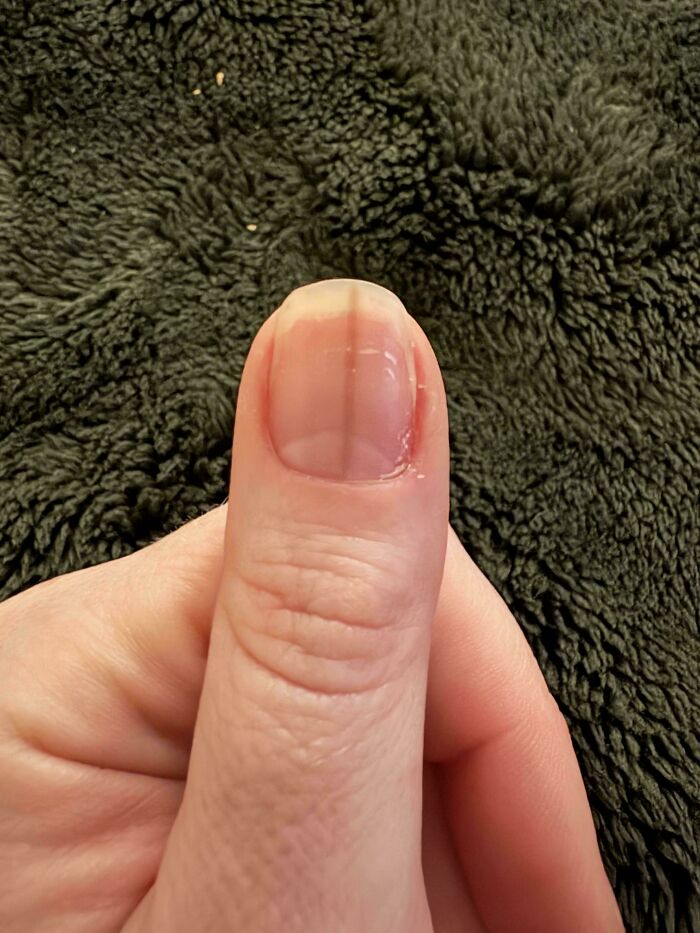 A thumb with a distinct dark vertical line down the nail, a rare and unexpected body quirk.