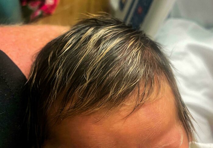 A close-up of a baby's head with a patch of light-colored hair contrasting with darker hair, a rare body quirk.