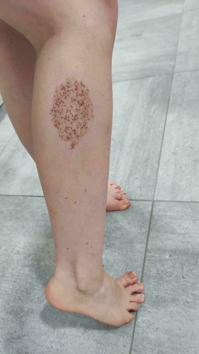 A unique pattern of small brown spots forming an oval shape on a person's lower leg, a fascinating body quirk.