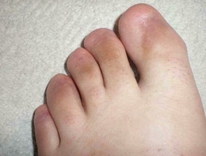 A close-up of a foot with unusually shaped and colored toes, displaying unexpected body quirks.
