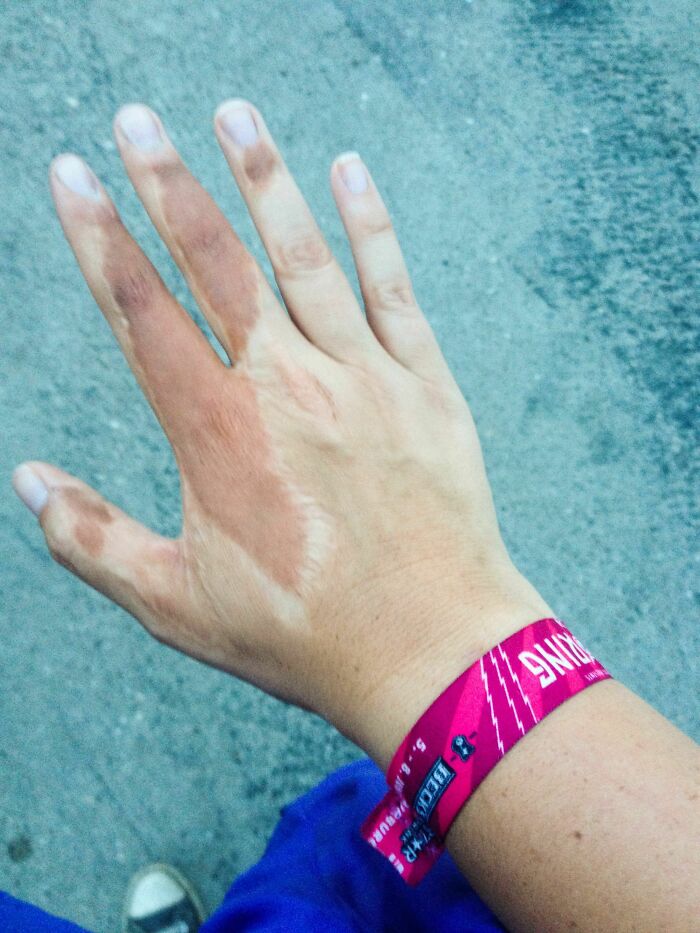 A hand with a distinct pattern of pale skin patches, revealing fascinating body quirks.