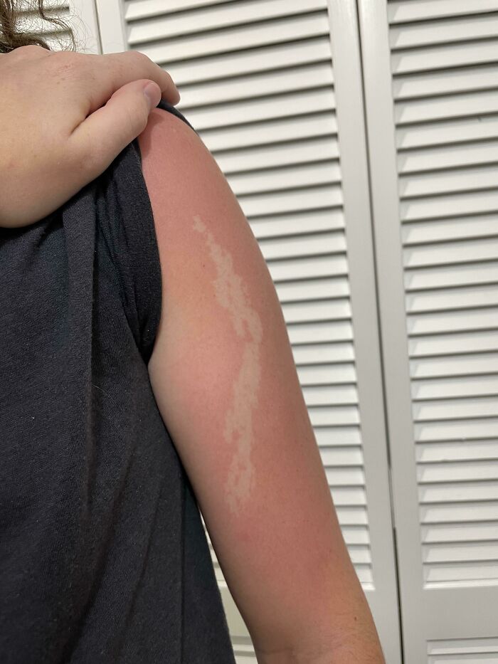 An arm with a pale, lightning-bolt shaped mark on sun-reddened skin, showcasing rare body quirks.