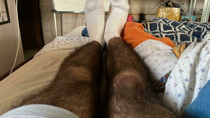 A person's legs with unusually hairy thighs contrasting with pale shins and feet, a striking body quirk.