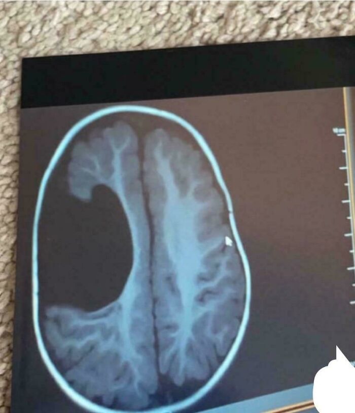 An MRI scan revealing an uncommon brain structure, a compelling example of a body quirk.