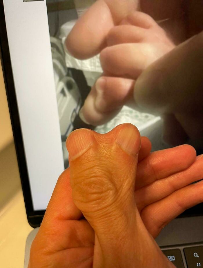 A person holding up their unusual thumb, displaying a rare and unexpected body quirk.