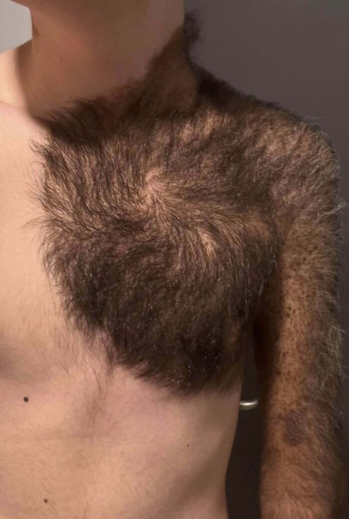A person with a large patch of thick, dark hair covering their shoulder and chest, showcasing a rare body quirk.