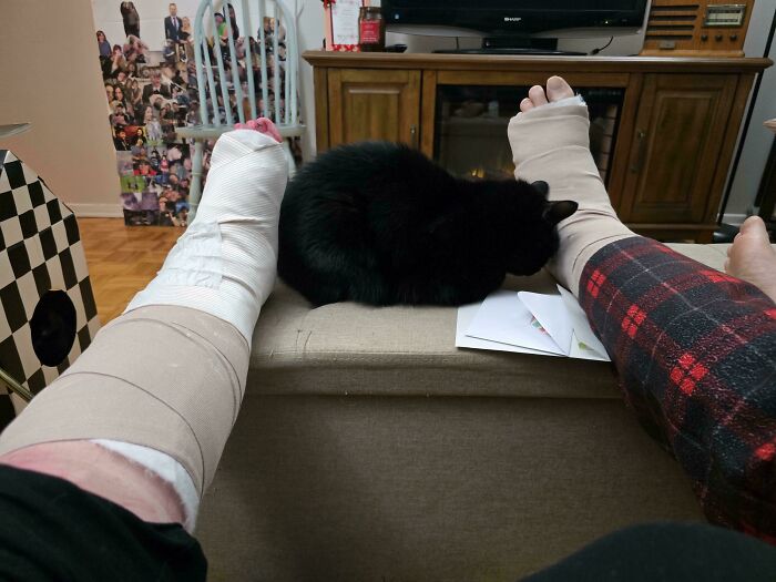 A black cat perfectly synced between two bandaged legs on a couch, creating an amazing moment.