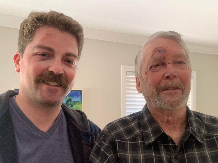Two men, possibly father and son, with matching black eyes and facial injuries, showing an amazing synced accident.