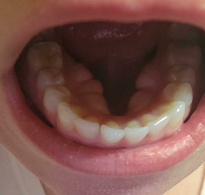 Rare physical feature of underbite teeth in mouth close-up