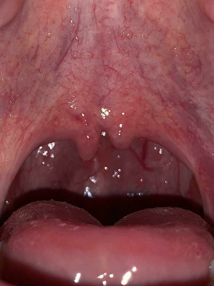Throat with rare uvula split visible inside mouth