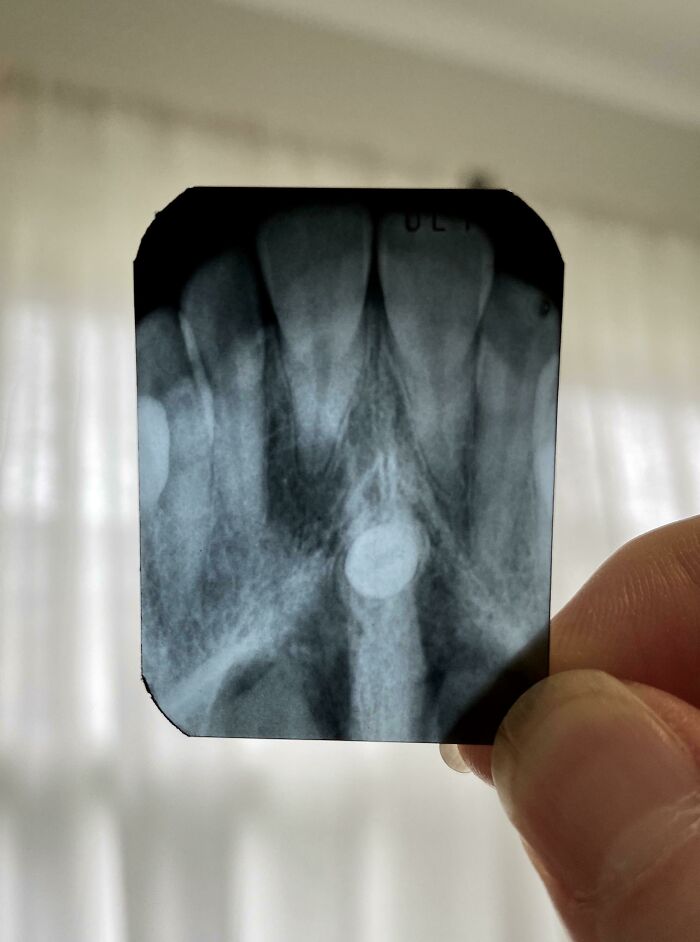 X-ray showing rare tooth anomaly in dental structure