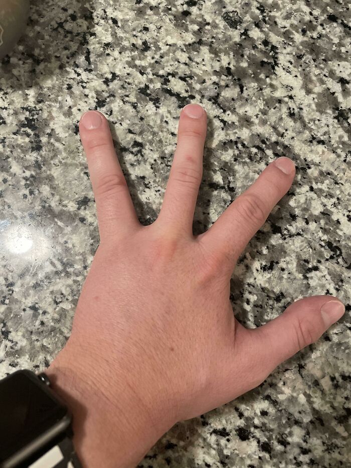 Hand with rare four fingers shown on granite countertop