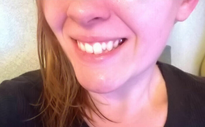 Close-up of a rare dental feature smiling with unique teeth alignment