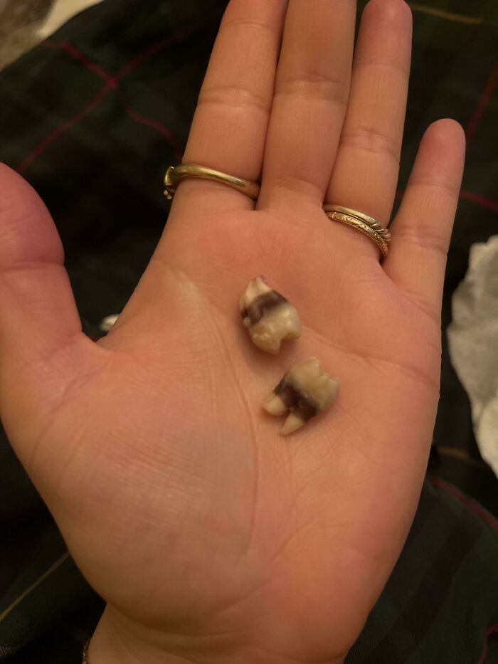 Hand holding two extracted teeth with unusual coloring and shape