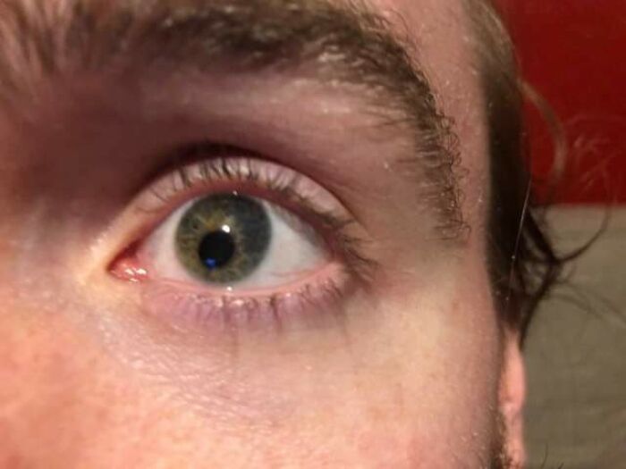 Close-up of an eye with unusual physical feature and unique iris colors