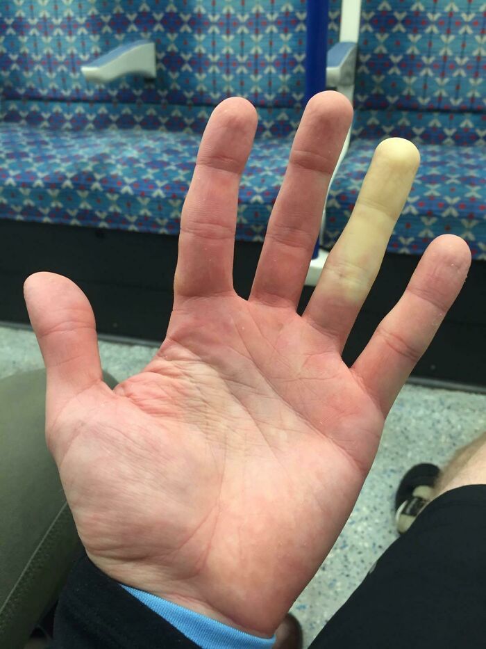 Hand showing rare physical feature with one finger pale from Raynaud's phenomenon