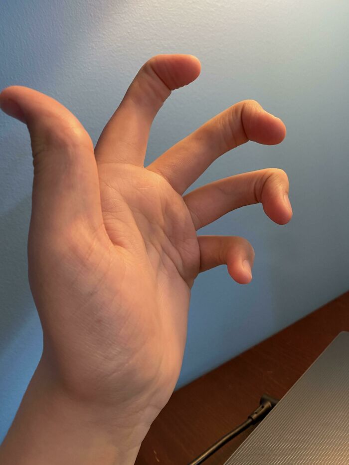 Hand displaying rare finger joint curvature and flexibility