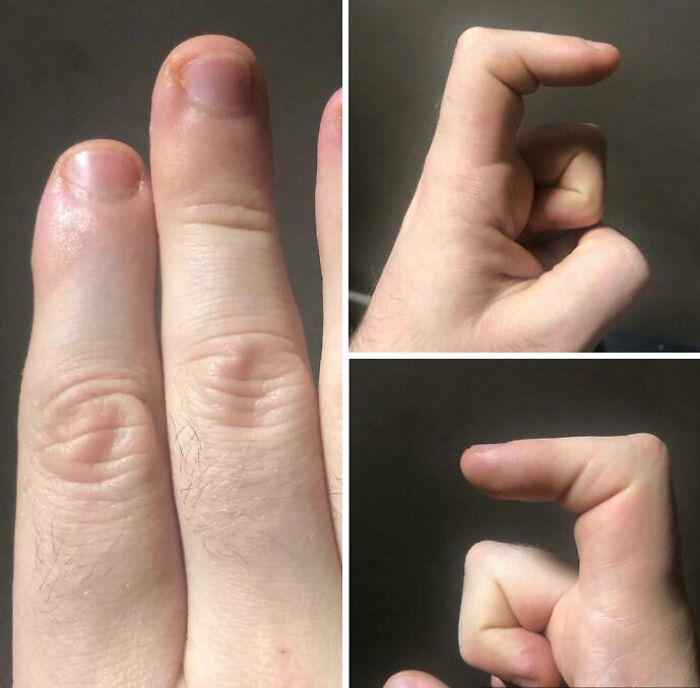 Three photos showing fingers with unique joint flexibility