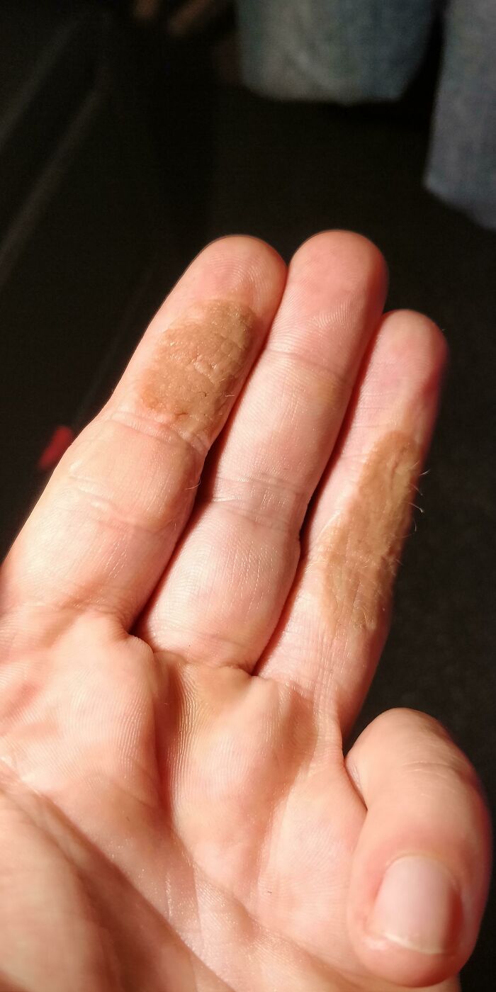 Close-up of fingers with rare skin pigmentation on two fingertips