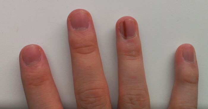 Fingers showing rare nail groove, a unique physical feature