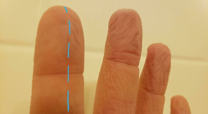 Unique finger shape with a straight blue line highlighting rare physical features