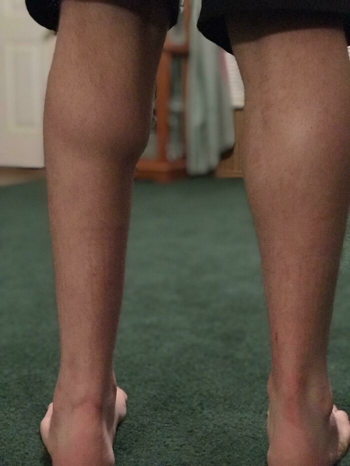 Legs showing rare physical features asymmetry in calves