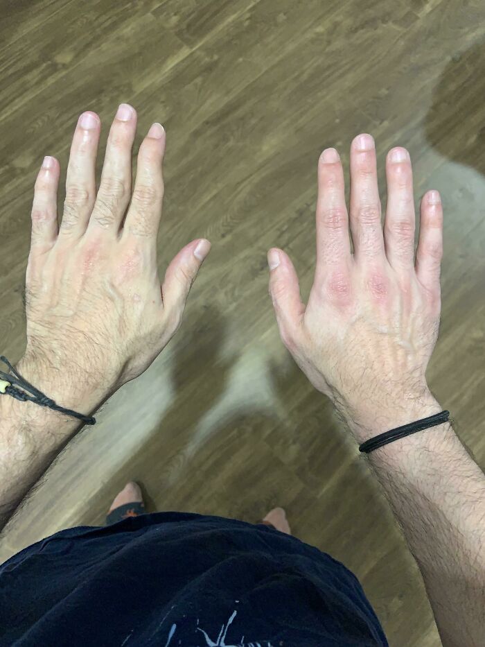 Unique physical features shown by hands with irregular veins and skin tone