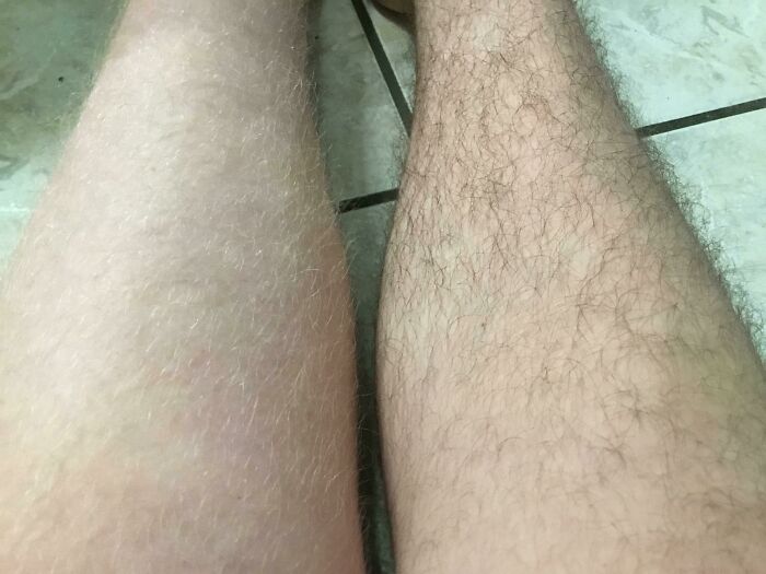 Legs with stark contrast in hair density illustrating rare physical feature