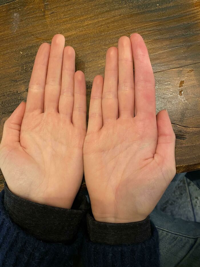 Rare physical feature showing hands with unusual finger length and shape