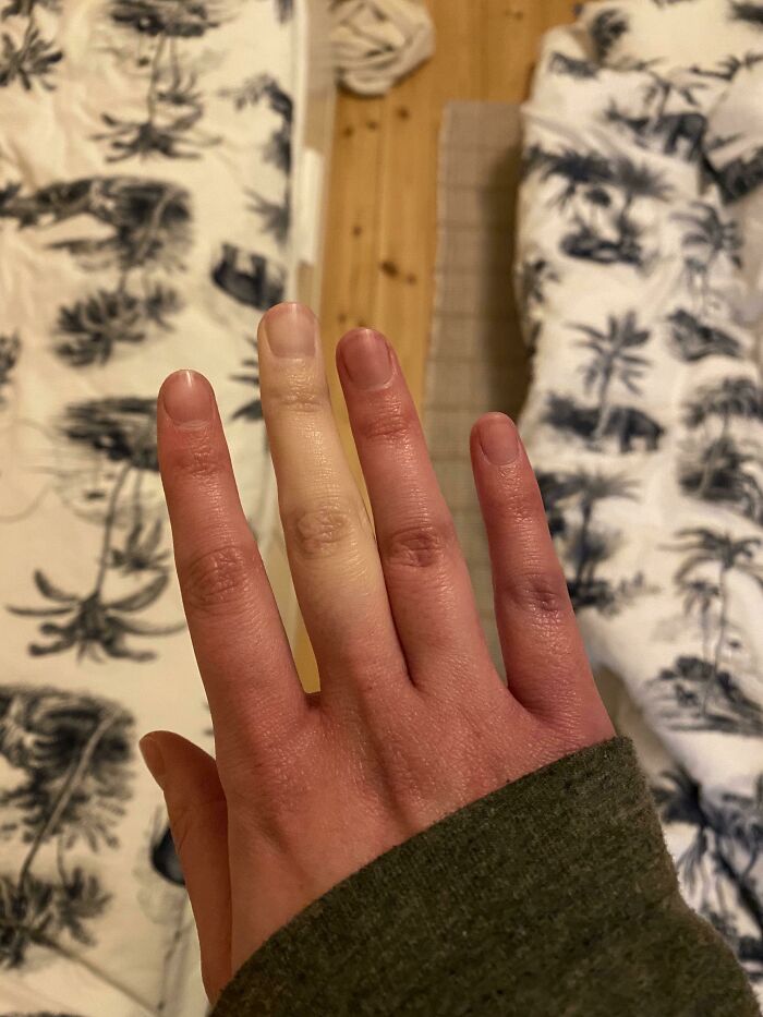 Hand exhibiting rare skin pigmentation with one pale finger