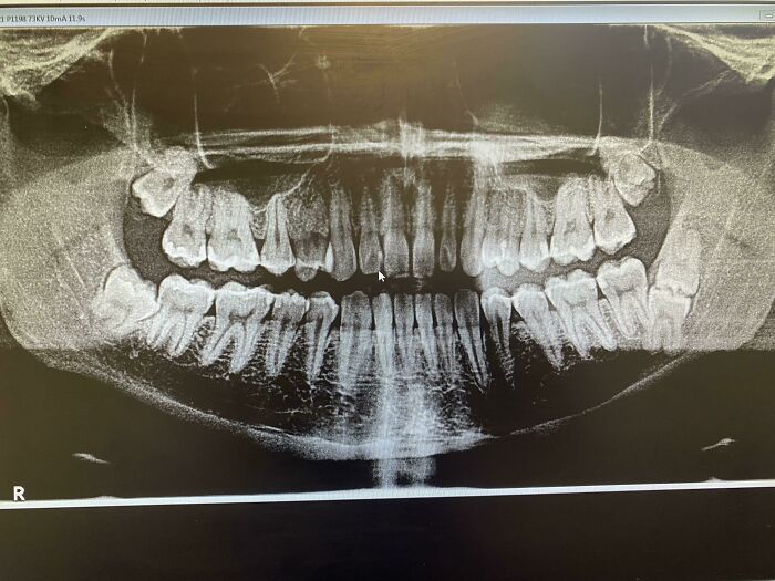 Dental X-ray showing rare physical tooth arrangement