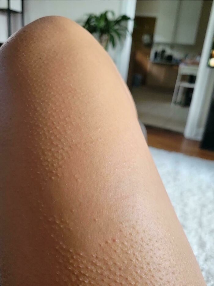 Skin with goosebumps showing rare physical features on arm