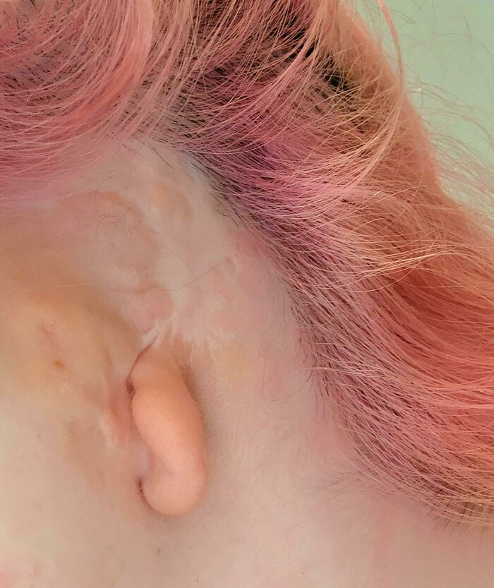 Close-up of rare physical ear deformity with pink hair