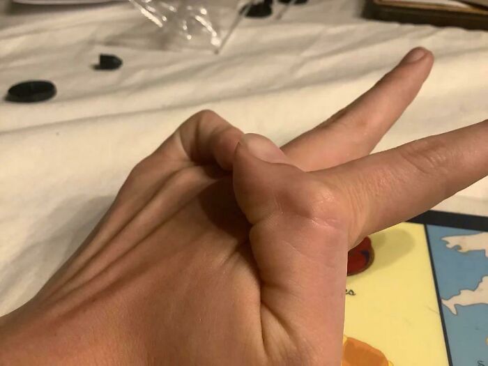 Hand demonstrating a rare hyperflexible finger bending backward